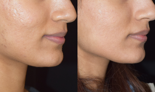 rf laser skin rejuvenation acne scarring before after mississauga oakville